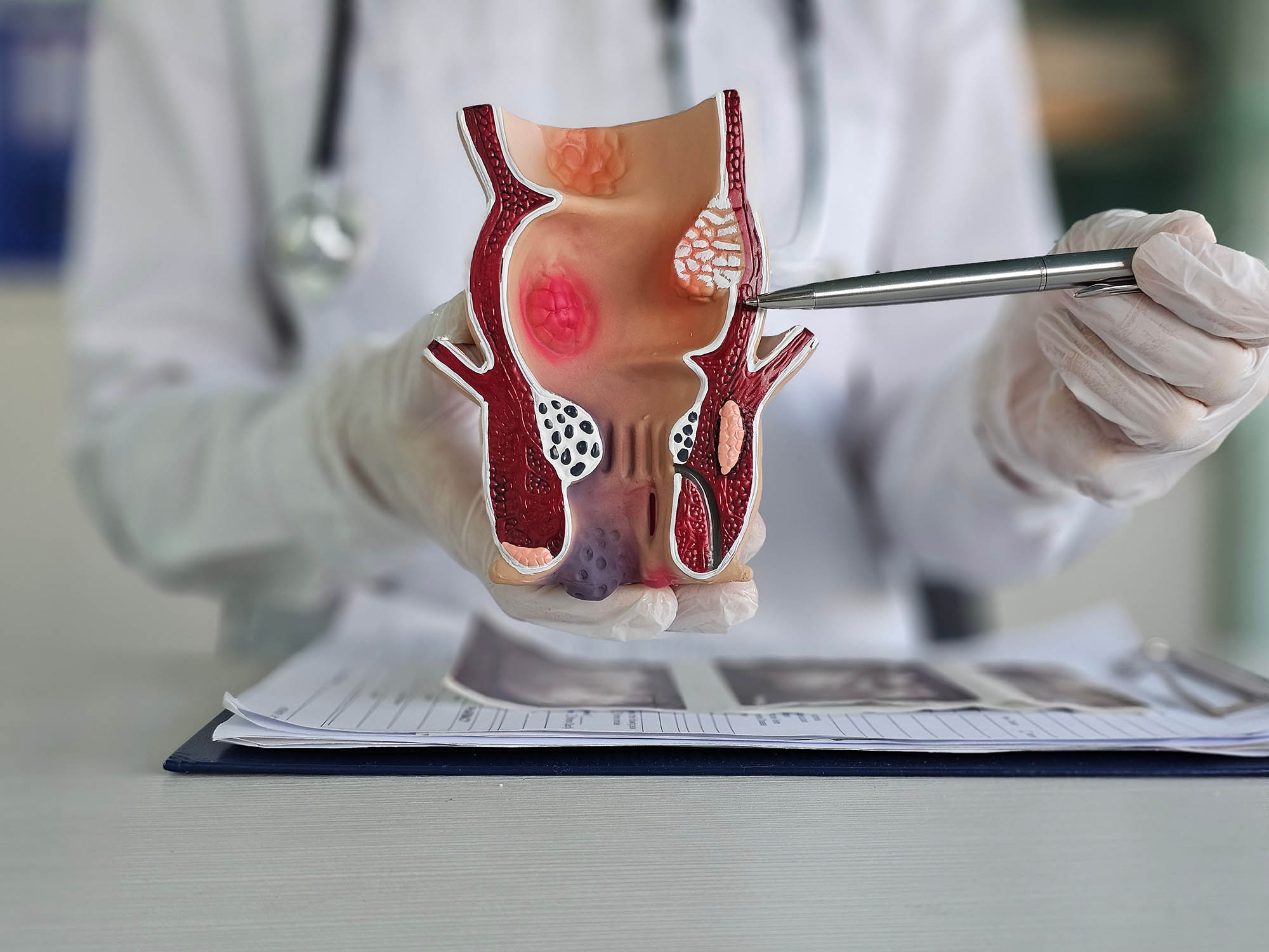 understanding hemorrhoids
